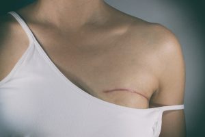 Breast cancer surgery scars